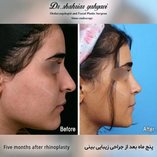 جراحی-بینی-533