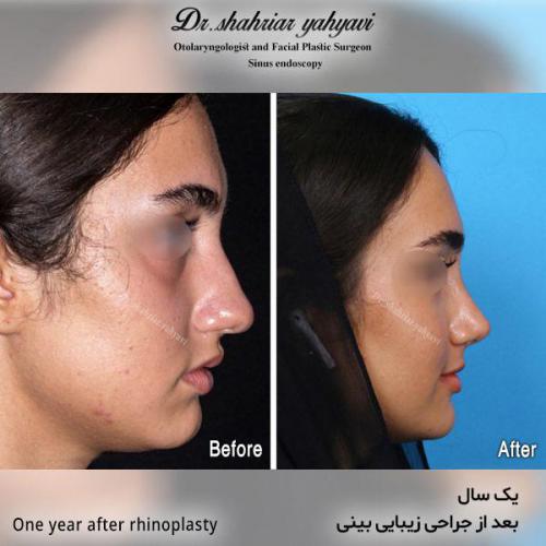 جراحی-بینی-536