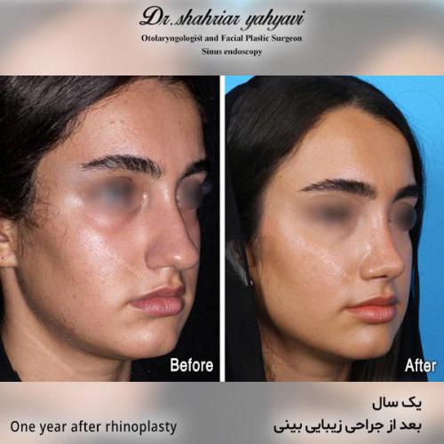 جراحی-بینی-537