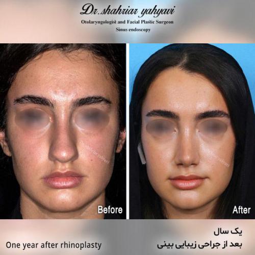 جراحی-بینی-538