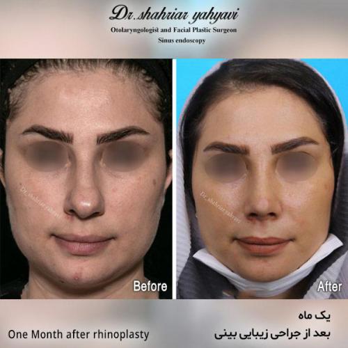 جراحی-بینی-539