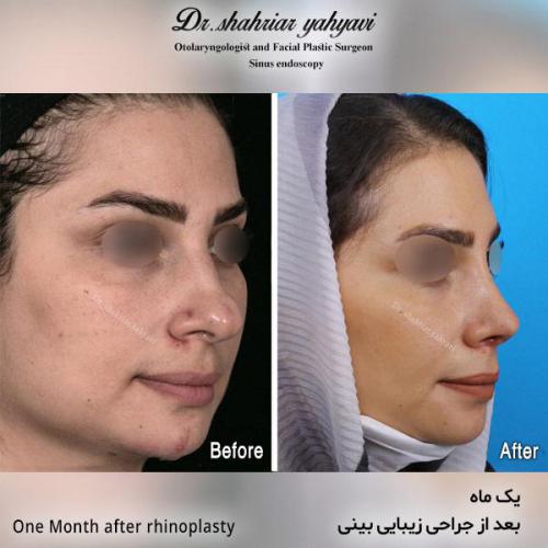 جراحی-بینی-540
