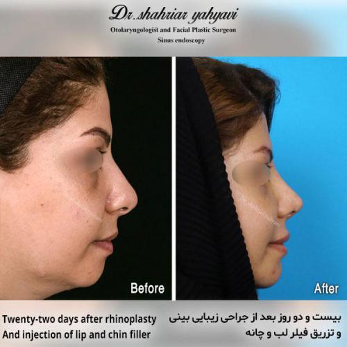 جراحی-بینی-542