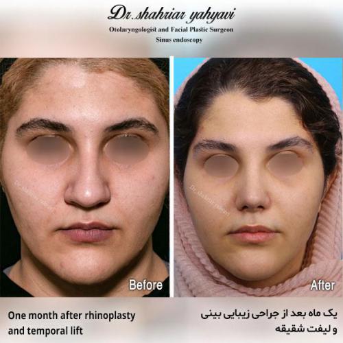 جراحی-بینی-544