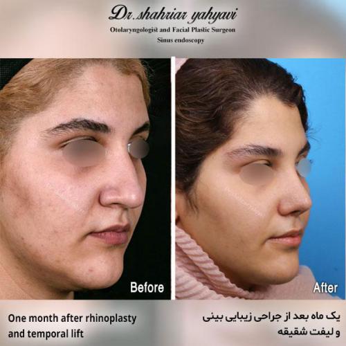 جراحی-بینی-546