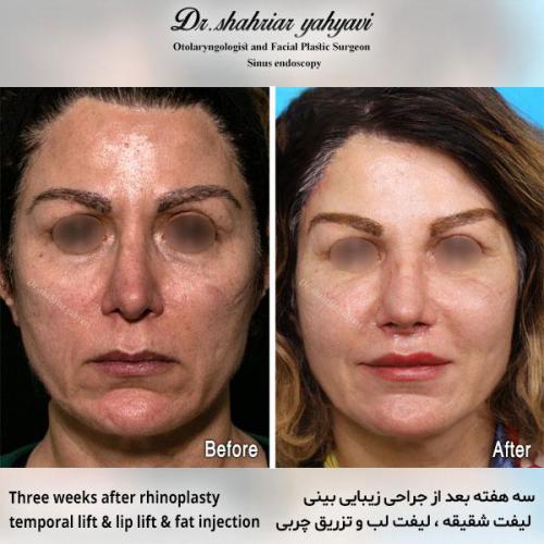 جراحی-بینی-549