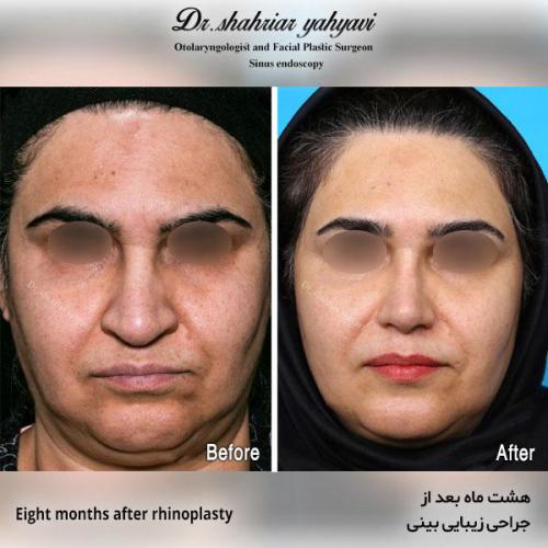 جراحی-بینی-550