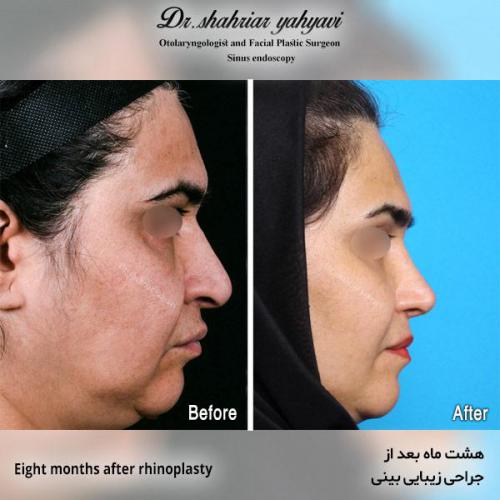 جراحی-بینی-551