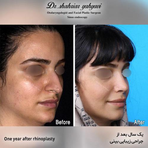 جراحی-بینی-552