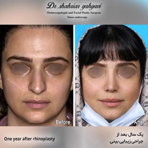 جراحی-بینی-553