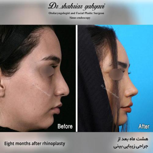 جراحی-بینی-554