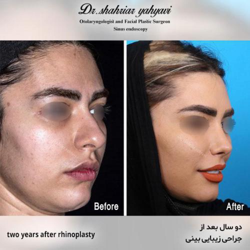 جراحی-بینی-557