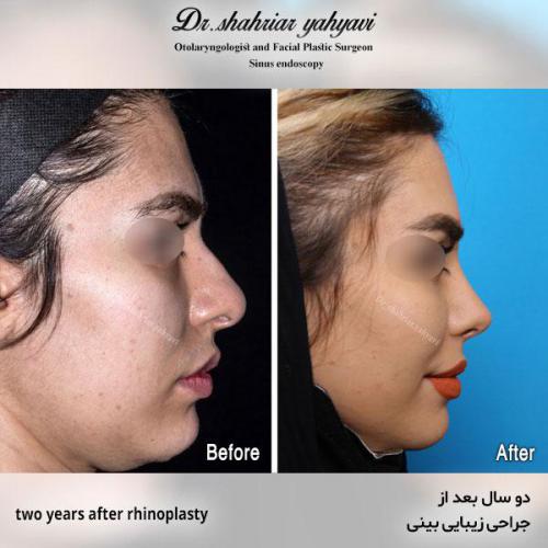 جراحی-بینی-558