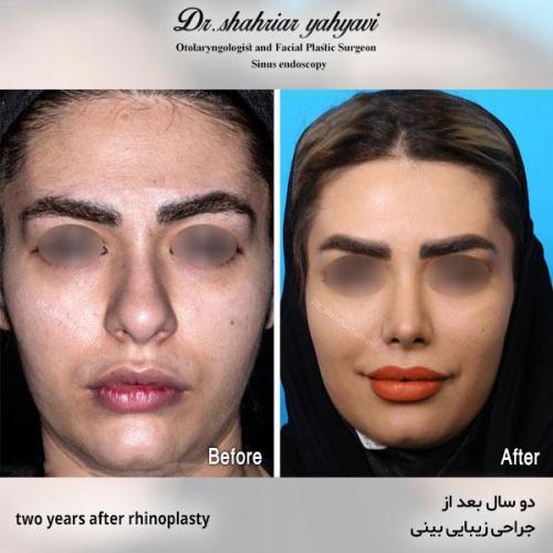 جراحی-بینی-559
