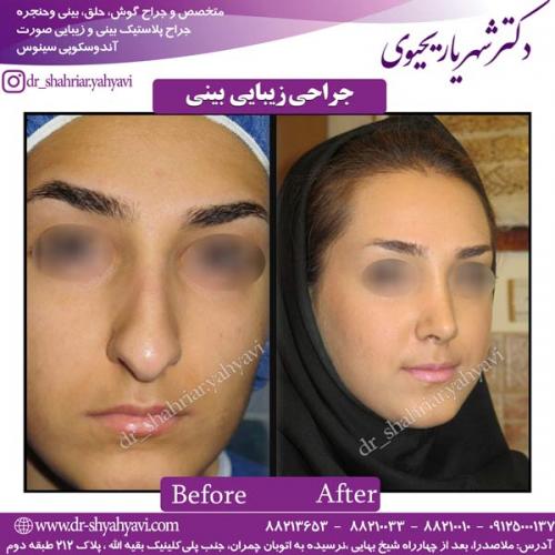 جراحی-بینی-56