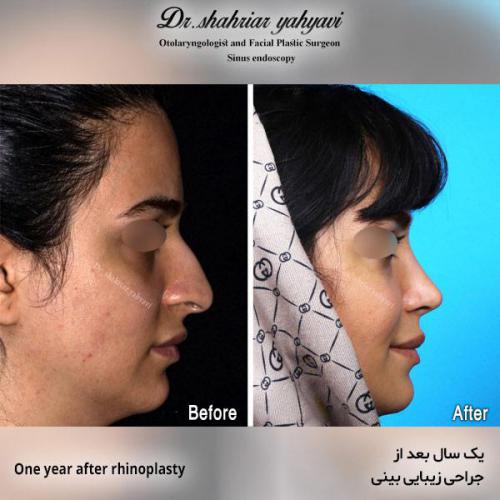 جراحی-بینی-560