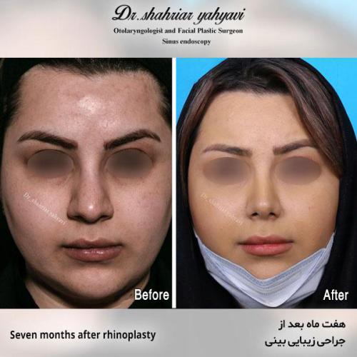 جراحی-بینی-561