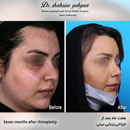 جراحی-بینی-562