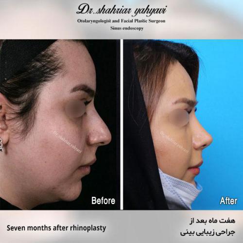 جراحی-بینی-563