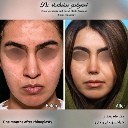 جراحی-بینی-564