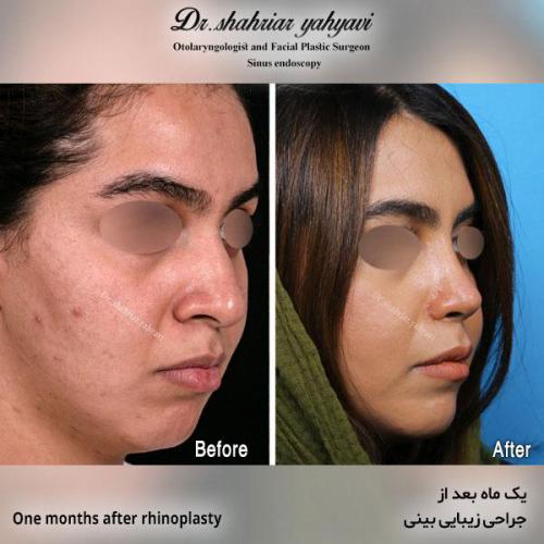 جراحی-بینی-565