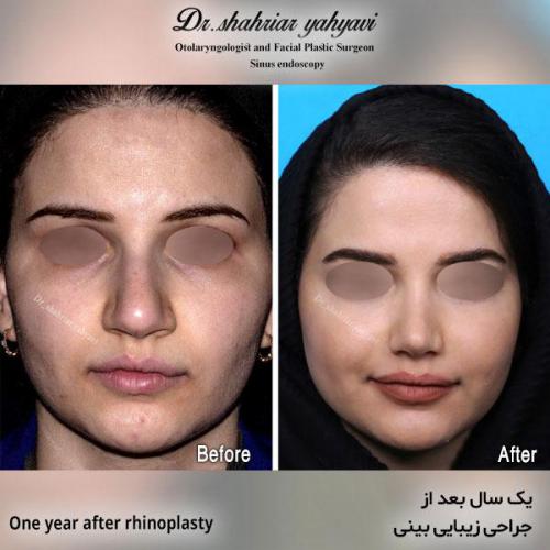 جراحی-بینی-567