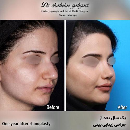 جراحی-بینی-568