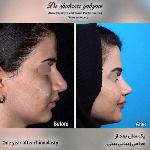جراحی-بینی-569