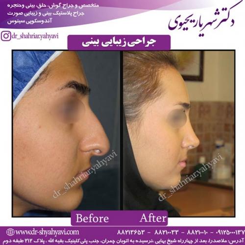 جراحی-بینی-57