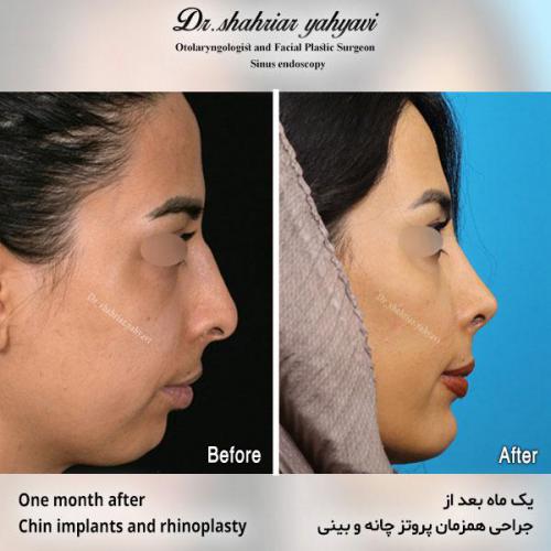 جراحی-بینی-571