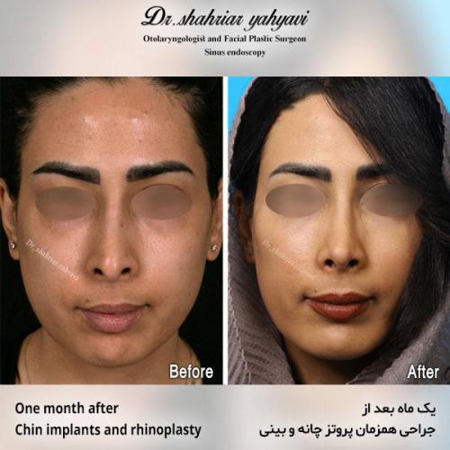 جراحی-بینی-572