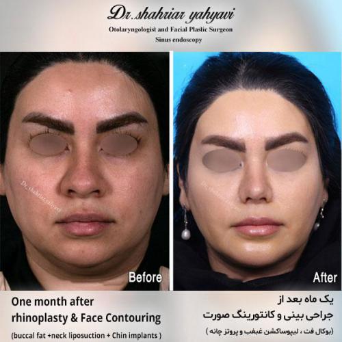جراحی-بینی-573