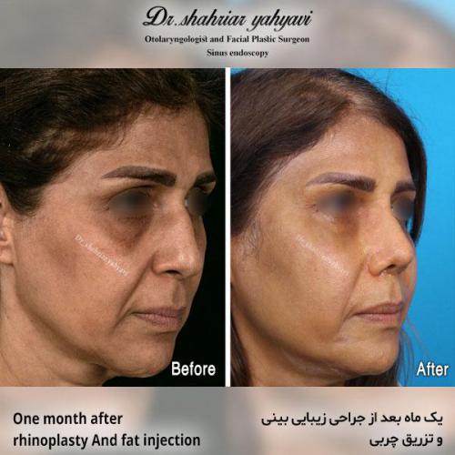 جراحی-بینی-575