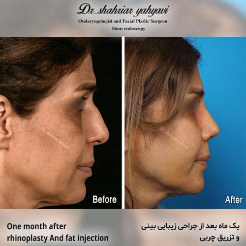 جراحی-بینی-576