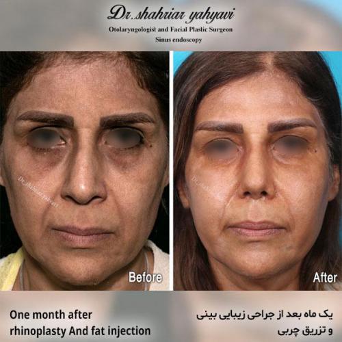 جراحی-بینی-577