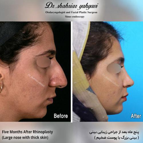 جراحی-بینی-578