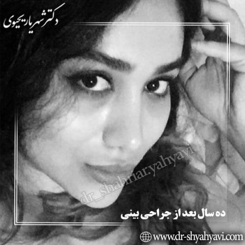 جراحی-بینی-58