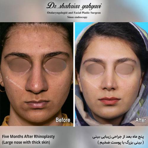 جراحی-بینی-580