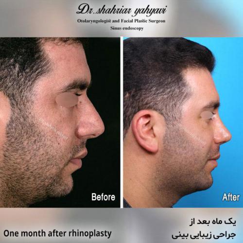 جراحی-بینی-581