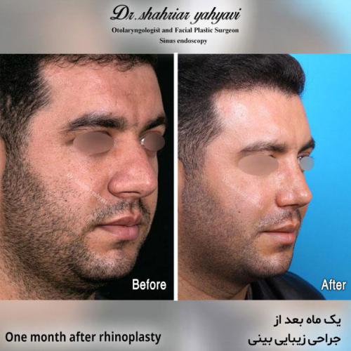 جراحی-بینی-582