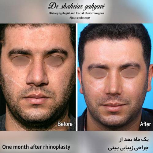 جراحی-بینی-583