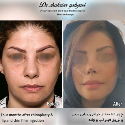 جراحی-بینی-584