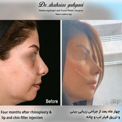 جراحی-بینی-585