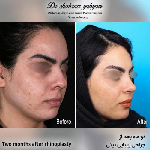 جراحی-بینی-586