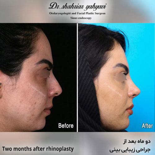 جراحی-بینی-587