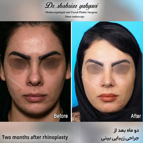 جراحی-بینی-588