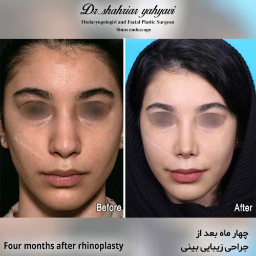 جراحی-بینی-589