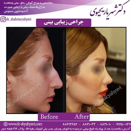 جراحی-بینی-59