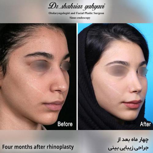 جراحی-بینی-590