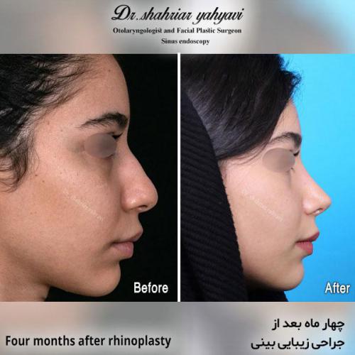 جراحی-بینی-591